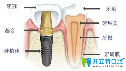 洛陽維樂口腔門診部種植牙示意圖