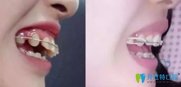 孝感口腔牙齒矯正效果