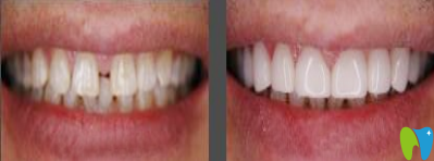 洛陽維樂口腔牙齒縫隙過大矯正效果