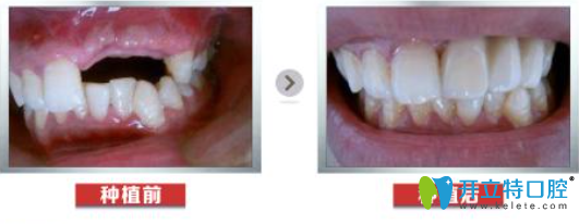 沈陽米加口腔種植牙案例