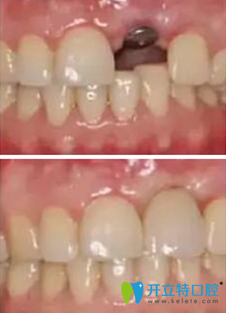 巴平妍醫(yī)師牙齒缺失修復案例