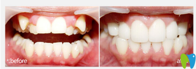 洛陽維樂口腔虎牙矯正效果