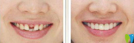 廈門宏沅膛口腔許保春種植牙效果對(duì)比圖