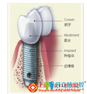 瑞典“諾貝爾”種植牙系統(tǒng)推薦