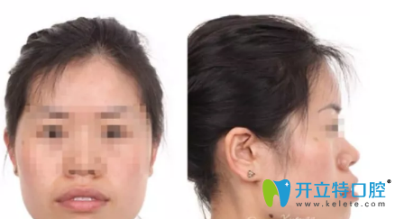 西安小白兔口腔做的牙齒矯正手術(shù)，忍受非一般的痛苦