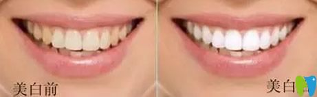 冷光美白牙齒效果對比圖