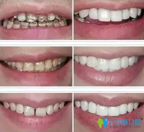 美白牙貼面是口腔美學(xué)修復(fù)的重要手段