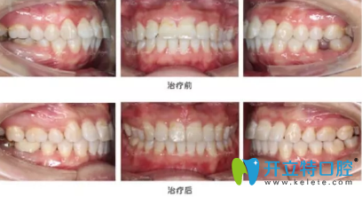 完全恢復(fù)之后我簡(jiǎn)直很開心，牙齒就這么完美了