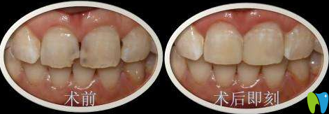 廈門(mén)宏沅膛謝良偉前牙美容性修復(fù)效果對(duì)比圖 廈門(mén)宏沅膛謝良偉前牙美容性修復(fù)效果對(duì)比圖