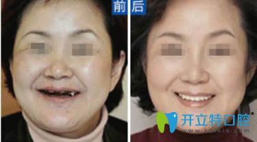 河源拜博牟啟蒙醫(yī)生全口種植牙案例 河源拜博牟啟蒙醫(yī)生全口種植牙案例
