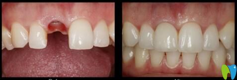 朝陽(yáng)牙博士牙齒缺失種植效果