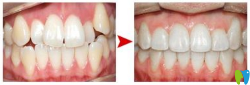 廈門宏沅膛陳少杰牙齒矯正效果對比圖