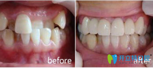 洛陽維樂口腔牙齒擁擠矯正效果