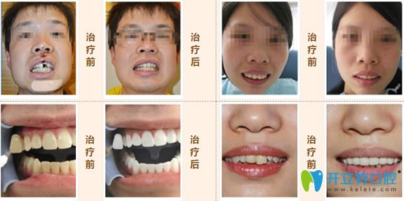 <!--<i data=20240703-sp></i>-->口腔真人案例 <!--<i data=20240703-sp></i>-->口腔真人案例