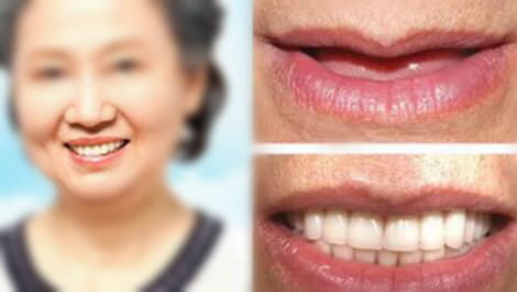 當(dāng)初朋友堅持在鄭州德貝口腔做種植牙，現(xiàn)在他就變成這樣