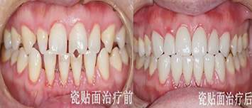 曬遵義華美口腔真人3D牙貼面修復案例過程及效果圖