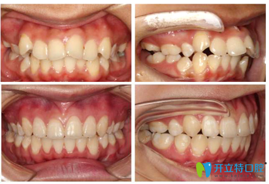 佛山拜博口腔王增全院長牙齒矯正案例對(duì)比圖