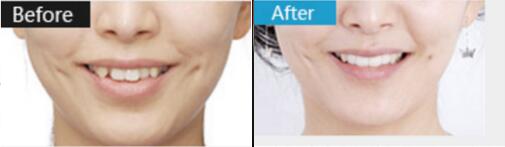 什么是數(shù)字化矯正牙齒？烏魯木齊美奧口腔張翔做的牙齒矯