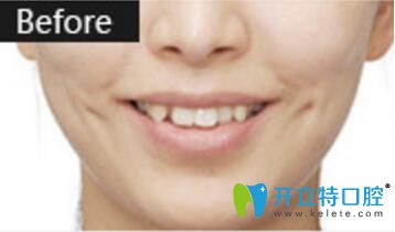 烏魯木齊美奧口腔張翔牙齒矯正真人案例術前照