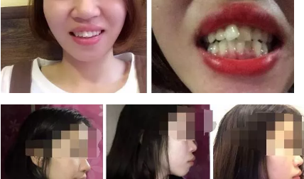 西安諾貝爾口腔做的牙齒矯正，給有備孕又想帶牙套的