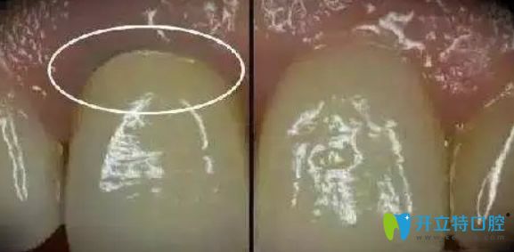 烤瓷牙使用久了容易引發(fā)口腔疾病 烤瓷牙使用久了容易引發(fā)口腔疾病