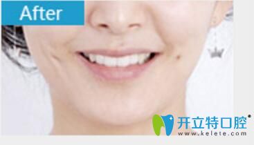 烏魯木齊美奧口腔張翔牙齒矯正真人案例術后照