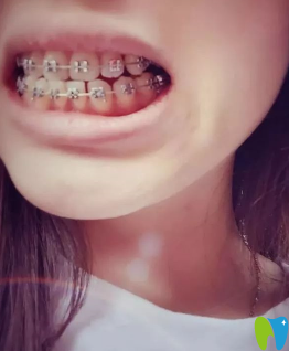 在沈陽(yáng)愛齒口腔矯正后一年的樣子