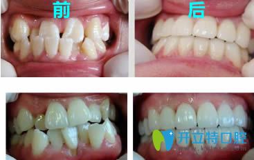 河源拜博周偉安醫(yī)生牙齒矯正前后對(duì)比案例 河源拜博周偉安醫(yī)生牙齒矯正前后對(duì)比案例