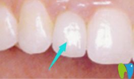 龍巖萬(wàn)翔口腔牙齒種植效果 龍巖萬(wàn)翔口腔牙齒種植效果