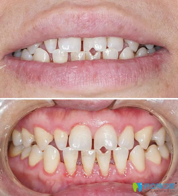 遵義華美口腔3D牙貼面前牙齒照片 遵義華美口腔3D牙貼面前牙齒照片