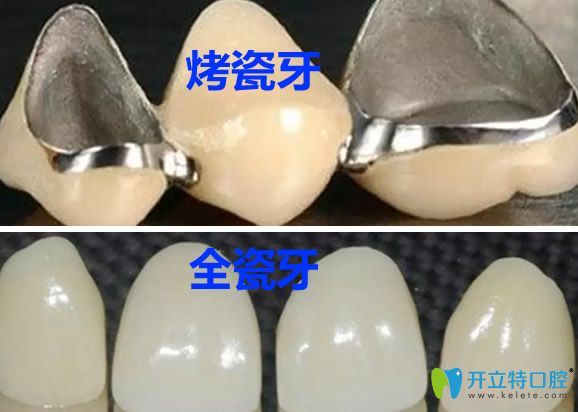 全瓷牙和烤瓷牙所用材料不同 全瓷牙和烤瓷牙所用材料不同