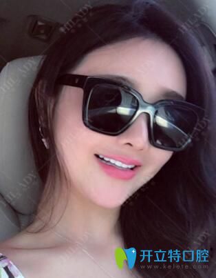 做牙貼面美白一周效果
