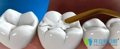 補牙多少錢 補牙多少錢