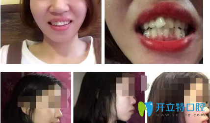 分享我在西安諾貝爾口腔做的牙齒矯正日記