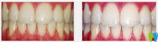 漯河蘇瑞品口腔牙齒冷光美白案例 漯河蘇瑞品口腔牙齒冷光美白案例