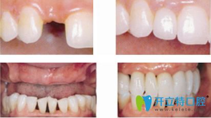 萬(wàn)翔口腔單顆和多顆牙種植效果案例 萬(wàn)翔口腔單顆和多顆牙種植效果案例