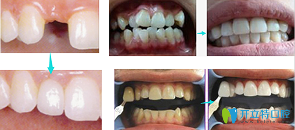   龍巖萬翔口腔種植牙、牙齒矯正和牙齒美白效果對比圖