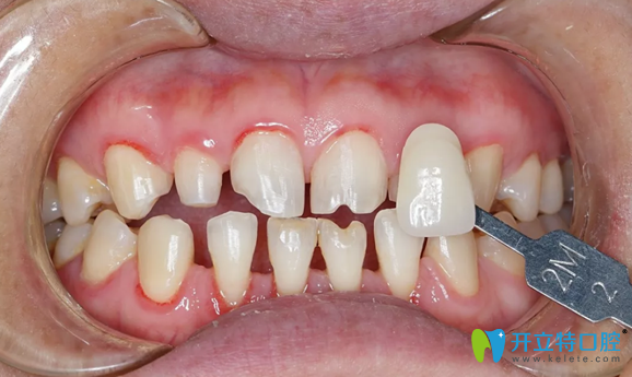 遵義華美牙齒貼面制作前基牙色比色 遵義華美牙齒貼面制作前基牙色比色