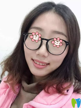 沈陽(yáng)愛齒口腔齙牙矯正兩年后效果