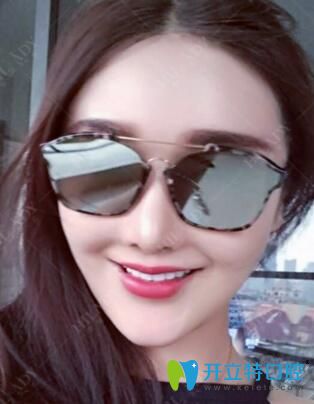 在華領口腔做超薄牙貼面2個月效果