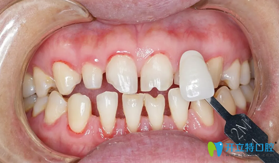 3D牙貼面制作前目標色比色 3D牙貼面制作前目標色比色