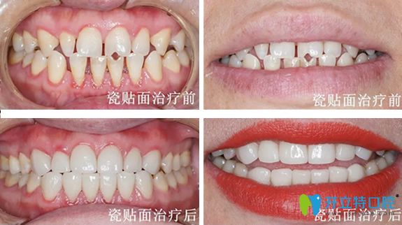 遵義華美口腔3D牙齒貼面治療前后對比照片 遵義華美口腔3D牙齒貼面治療前后對比照片