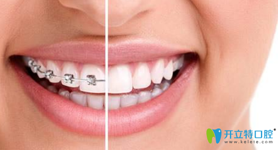 遵義華美口腔嬴胡川揭秘:成人矯正牙齒的后遺癥有哪些?