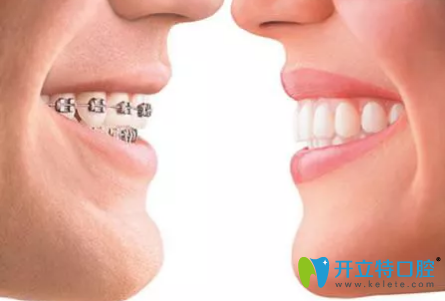 成年人做牙齒矯正 成年人做牙齒矯正