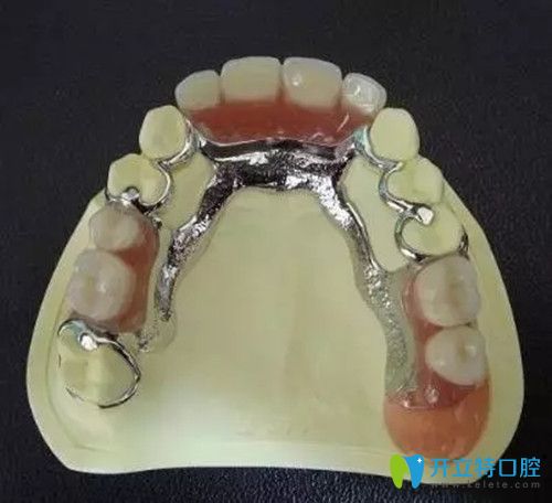 活動義齒 活動義齒