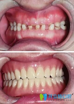 李曉莉院長牙齒咬合正畸案例