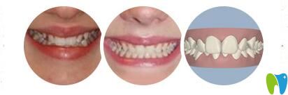 長(zhǎng)沙美萊口腔成人牙齒矯正