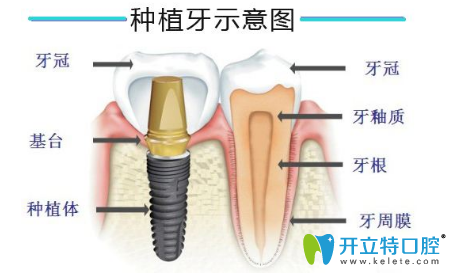 種植牙示意圖