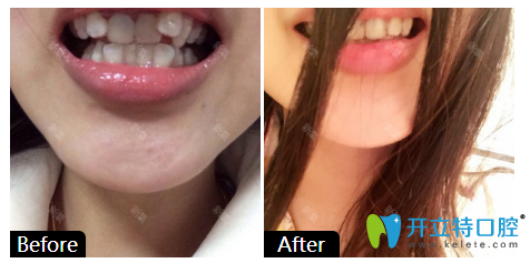 廣州柏德口腔牙齒矯正案例對比圖