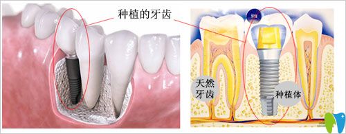 種植牙多少錢一顆?唐山拜博口腔分析種植牙價格的影響因素